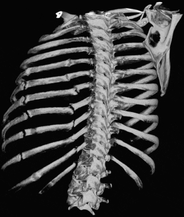 КТ костей скелета снимок